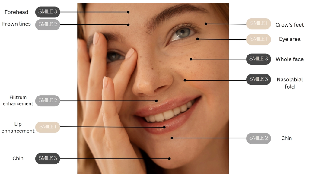 Smile Fill Global 1 (Cross Linked Hyaluronic Acid with Lidocaine) 1.0ml