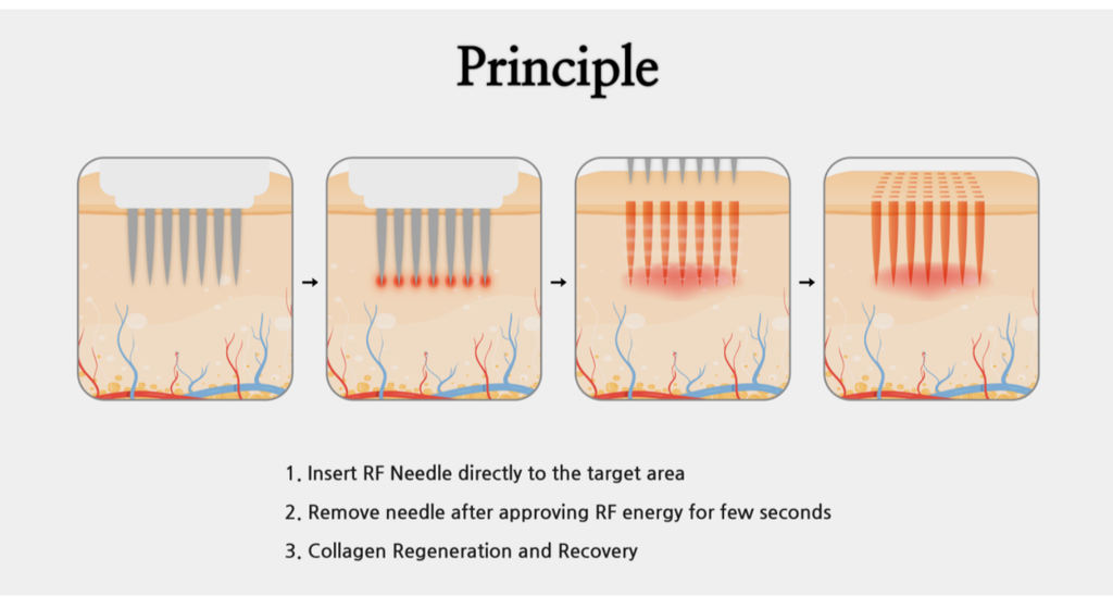 Explore (RF Needle System)