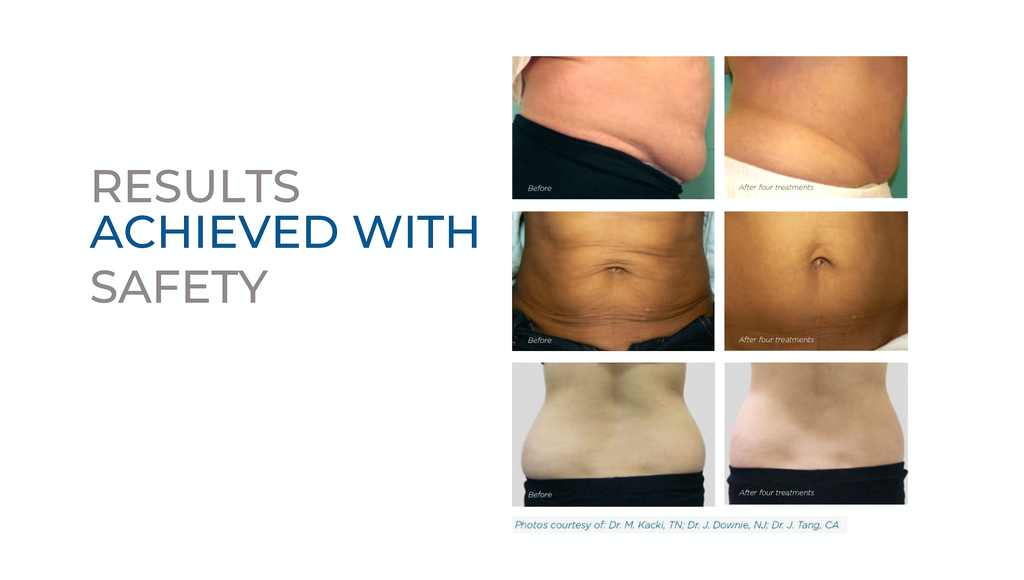 BTL Exilis Elite (Refurbished)