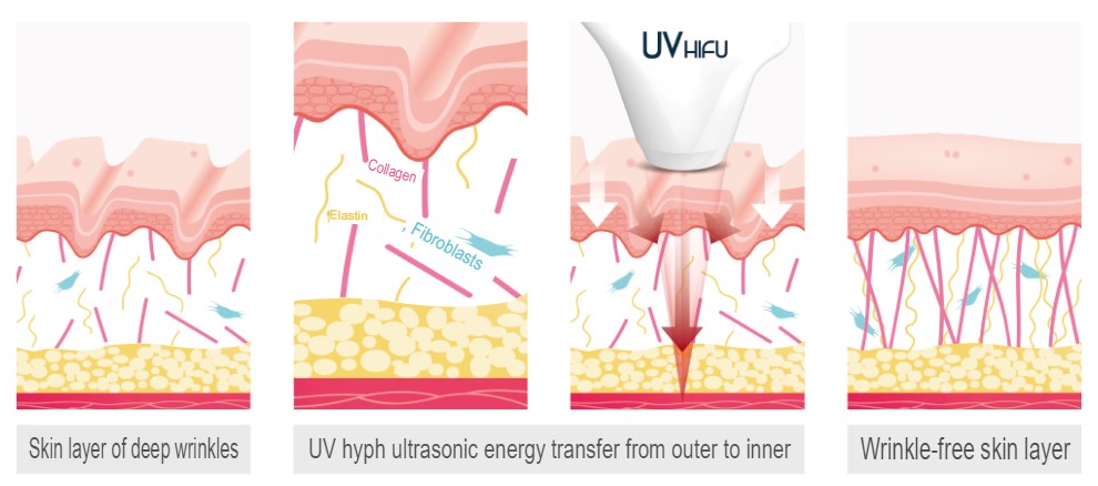 UV HIFU