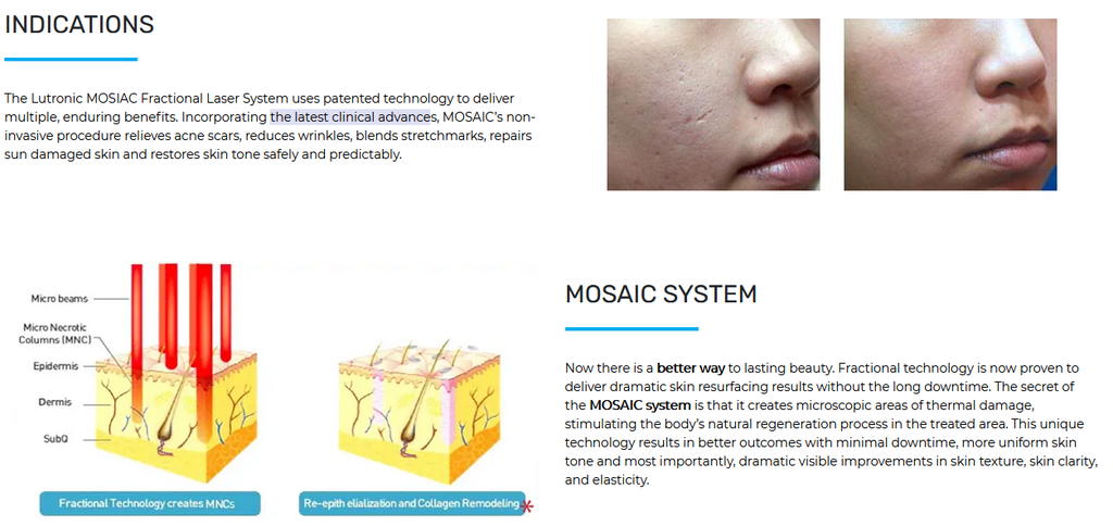 Mosaic Er Glass Fractional Laser (Refurbished)